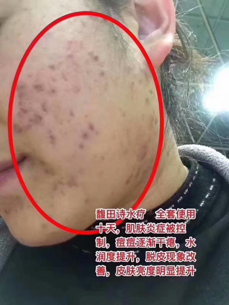 馥田詩(shī)水療，全套使用十天，肌膚炎癥被控制，痘痘逐漸干癟，水潤(rùn)度提升，脫皮現(xiàn)象改善，皮膚亮度明顯提升。